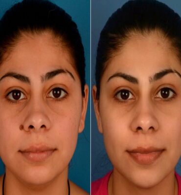 Herbal Remedies for Mole Remover in USA